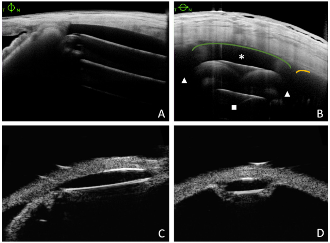 眼突计怎么用【惟视资讯】眼睛里植入一枚小芯片，术后不用跑医院，患者在家就能实现“测眼压自由”！准确性堪比“金标准”压平眼压计！_https://www.jmylbn.com_新闻资讯_第4张