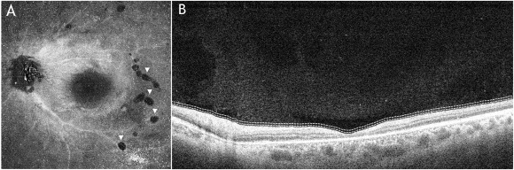 彩色眼底照相查什么【惟视诊室】炫彩眼底照相和Enface OCT让“虫洞”无所遁形_https://www.jmylbn.com_新闻资讯_第4张