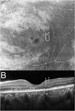 彩色眼底照相查什么【惟视诊室】炫彩眼底照相和Enface OCT让“虫洞”无所遁形_https://www.jmylbn.com_新闻资讯_第3张