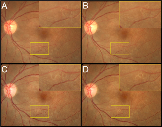 彩色眼底照相查什么【惟视诊室】炫彩眼底照相和Enface OCT让“虫洞”无所遁形_https://www.jmylbn.com_新闻资讯_第2张