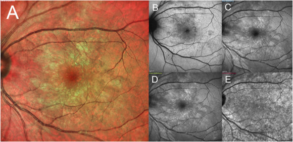 彩色眼底照相查什么【惟视诊室】炫彩眼底照相和Enface OCT让“虫洞”无所遁形_https://www.jmylbn.com_新闻资讯_第1张