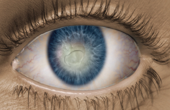 意大利眼科怎么样意大利东沛制药神经营养性角膜炎突破性生物疗法——欧适维®成功实现首例患者处方_https://www.jmylbn.com_新闻资讯_第3张