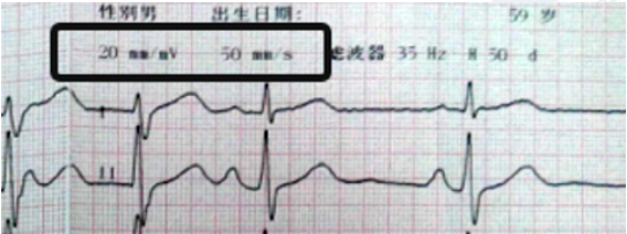 心电图纸怎么看考前突击：0 基础搞定心电图判读，看这一篇足够_https://www.jmylbn.com_新闻资讯_第4张
