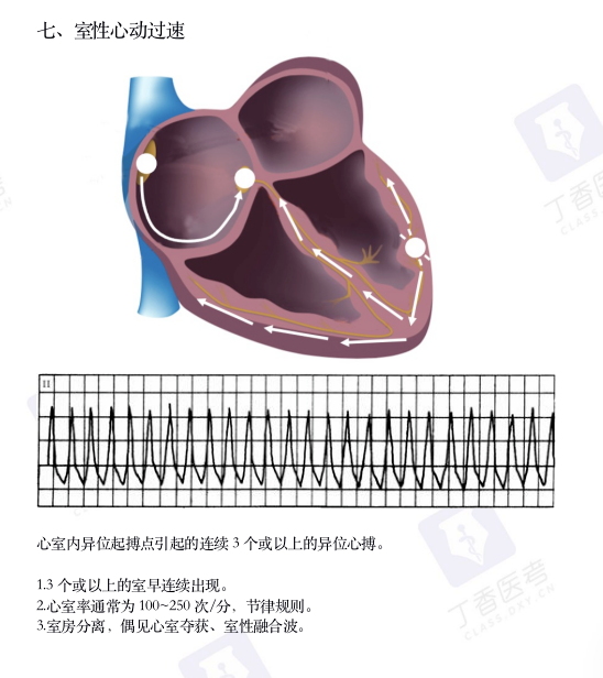 心电图纸怎么看考前突击：0 基础搞定心电图判读，看这一篇足够_https://www.jmylbn.com_新闻资讯_第11张