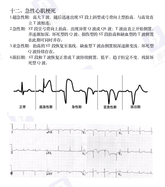 心电图纸怎么看考前突击：0 基础搞定心电图判读，看这一篇足够_https://www.jmylbn.com_新闻资讯_第20张