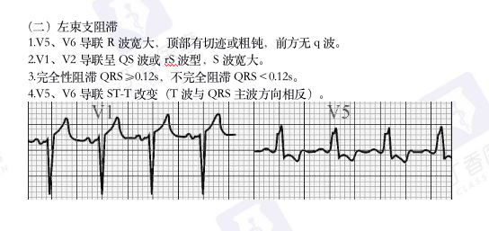 心电图纸怎么看考前突击：0 基础搞定心电图判读，看这一篇足够_https://www.jmylbn.com_新闻资讯_第17张
