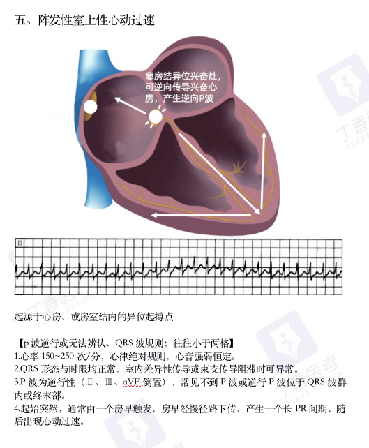 心电图纸怎么看考前突击：0 基础搞定心电图判读，看这一篇足够_https://www.jmylbn.com_新闻资讯_第9张