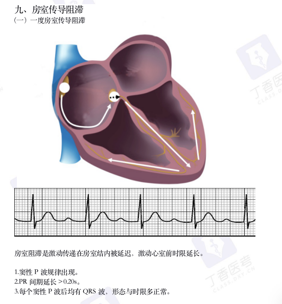 心电图纸怎么看考前突击：0 基础搞定心电图判读，看这一篇足够_https://www.jmylbn.com_新闻资讯_第13张
