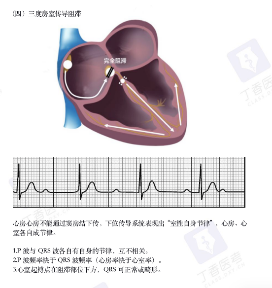 心电图纸怎么看考前突击：0 基础搞定心电图判读，看这一篇足够_https://www.jmylbn.com_新闻资讯_第15张