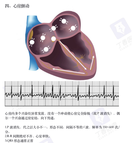 心电图纸怎么看考前突击：0 基础搞定心电图判读，看这一篇足够_https://www.jmylbn.com_新闻资讯_第8张