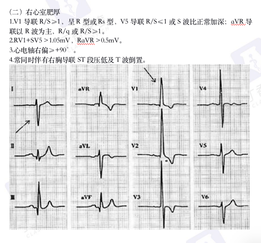 心电图纸怎么看考前突击：0 基础搞定心电图判读，看这一篇足够_https://www.jmylbn.com_新闻资讯_第19张