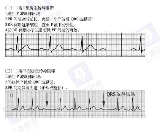 心电图纸怎么看考前突击：0 基础搞定心电图判读，看这一篇足够_https://www.jmylbn.com_新闻资讯_第14张