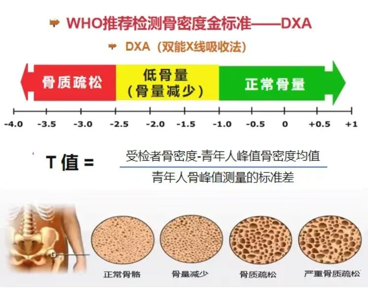 双能x骨密度检测仪为什么非得输入体重身高健康管理新利器：双能X线骨密度检测，助力骨骼与身体成分全面评估_https://www.jmylbn.com_新闻资讯_第5张
