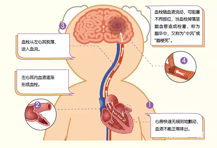 全彩3D打印助力心臟介入最有挑戰性的術式之左心耳封堵術的圖1