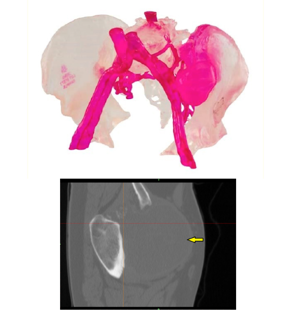 3D打印骨盆获得FDA批准，Onkos Surgical 已允许用于临床重建治疗的图2
