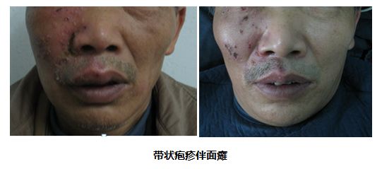 红光治疗怎么样红光、蓝光有什么不同？​红光主要消炎止痛、促进创面愈合？_https://www.jmylbn.com_新闻资讯_第4张