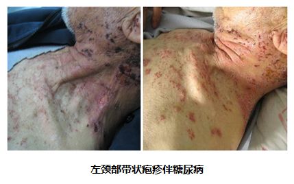 红光治疗怎么样红光、蓝光有什么不同？​红光主要消炎止痛、促进创面愈合？_https://www.jmylbn.com_新闻资讯_第5张