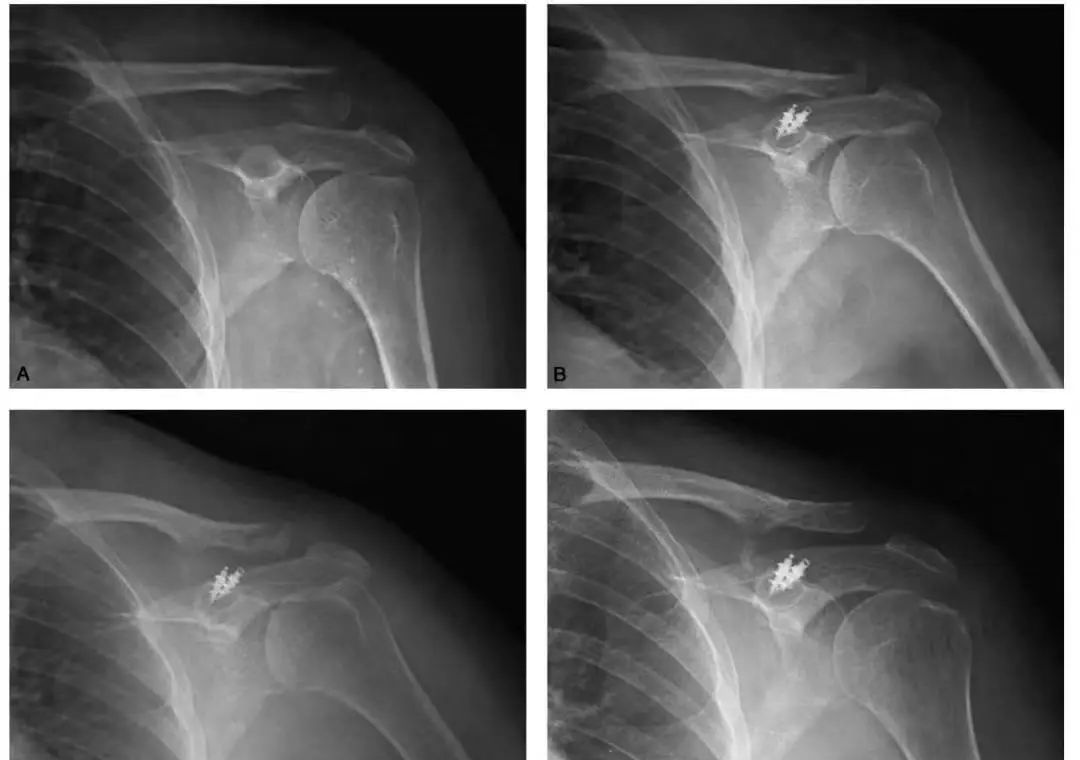 锁骨板有哪些【每周科普】锁骨骨折分中段、外段、内段，治疗方式也有差异_https://www.jmylbn.com_新闻资讯_第14张