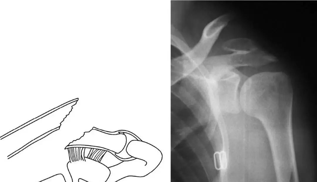 锁骨板有哪些【每周科普】锁骨骨折分中段、外段、内段，治疗方式也有差异_https://www.jmylbn.com_新闻资讯_第5张