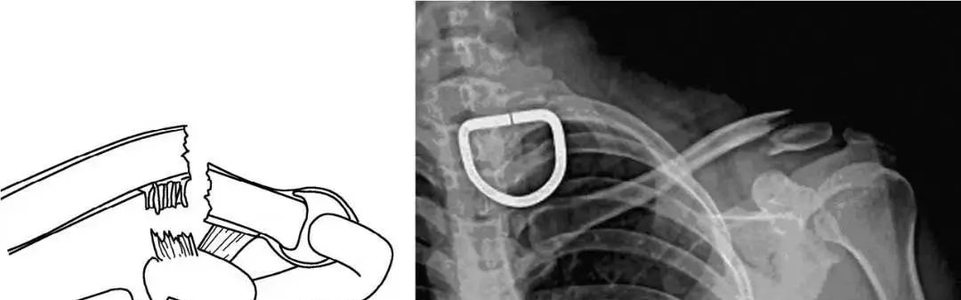 锁骨板有哪些【每周科普】锁骨骨折分中段、外段、内段，治疗方式也有差异_https://www.jmylbn.com_新闻资讯_第6张