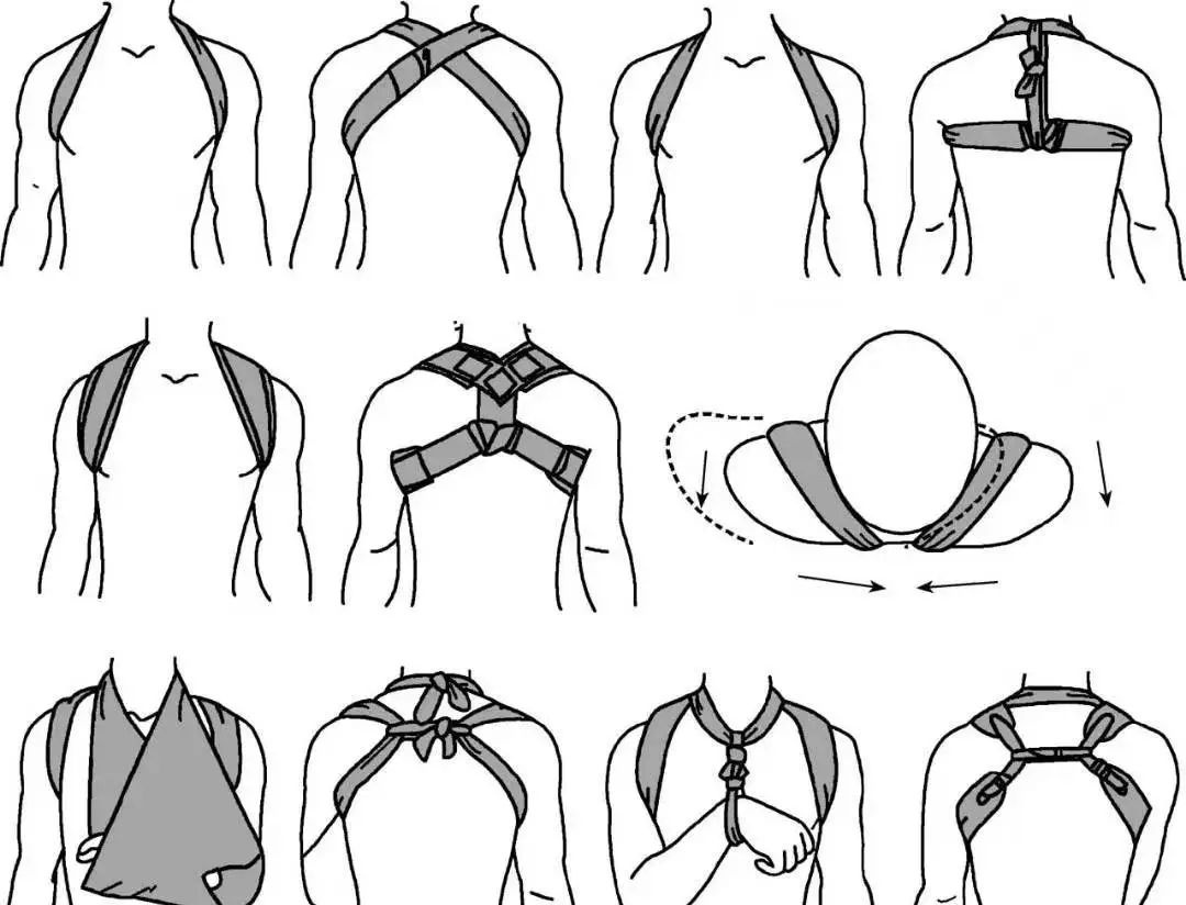 锁骨板有哪些【每周科普】锁骨骨折分中段、外段、内段，治疗方式也有差异_https://www.jmylbn.com_新闻资讯_第11张