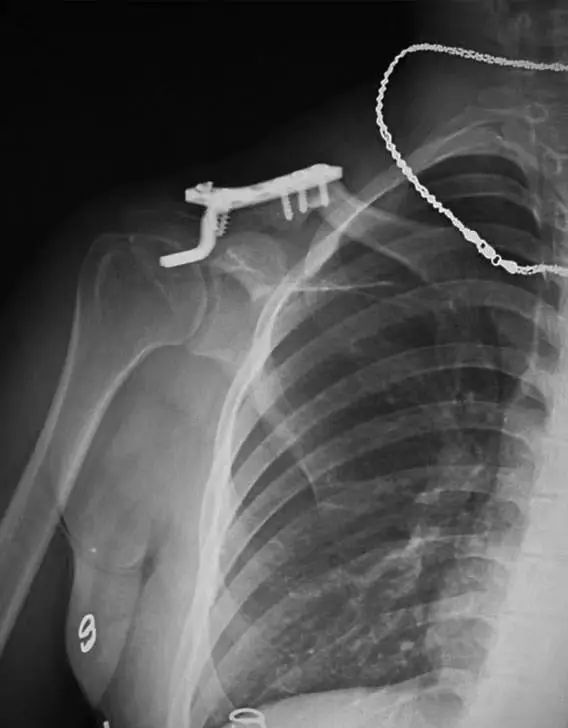 锁骨板有哪些【每周科普】锁骨骨折分中段、外段、内段，治疗方式也有差异_https://www.jmylbn.com_新闻资讯_第13张