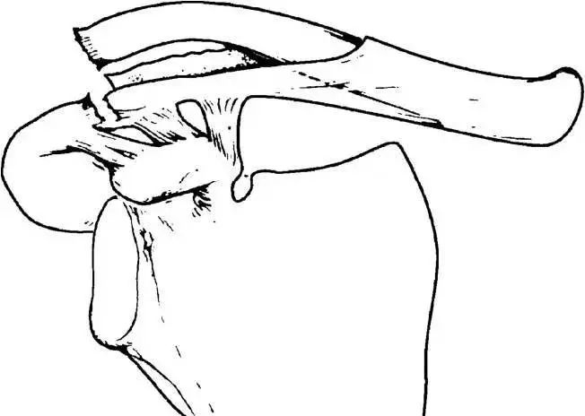 锁骨板有哪些【每周科普】锁骨骨折分中段、外段、内段，治疗方式也有差异_https://www.jmylbn.com_新闻资讯_第8张