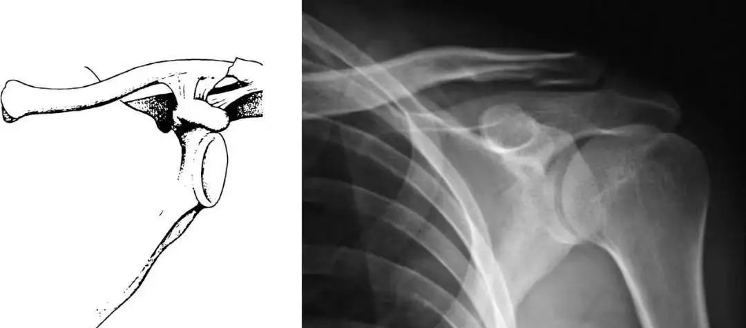 锁骨板有哪些【每周科普】锁骨骨折分中段、外段、内段，治疗方式也有差异_https://www.jmylbn.com_新闻资讯_第4张