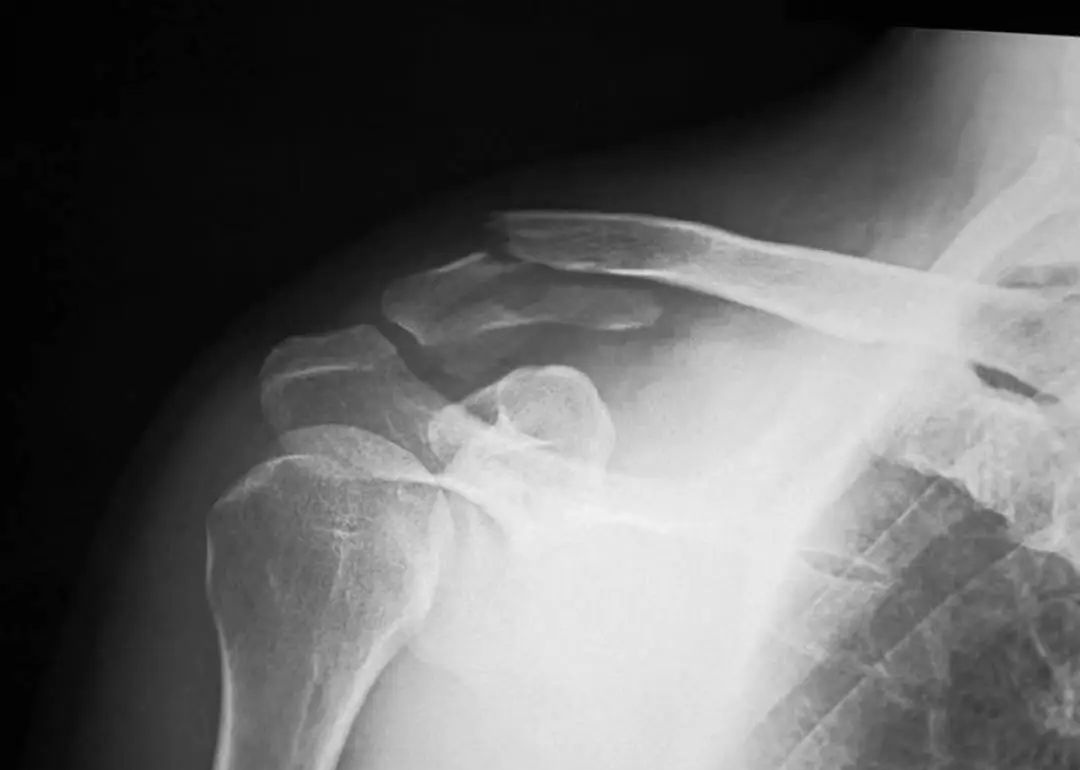 锁骨板有哪些【每周科普】锁骨骨折分中段、外段、内段，治疗方式也有差异_https://www.jmylbn.com_新闻资讯_第9张