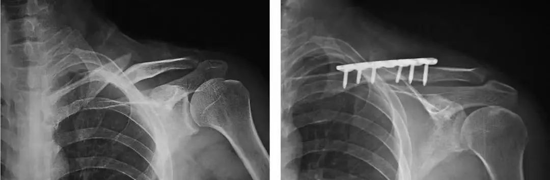 锁骨板有哪些【每周科普】锁骨骨折分中段、外段、内段，治疗方式也有差异_https://www.jmylbn.com_新闻资讯_第12张