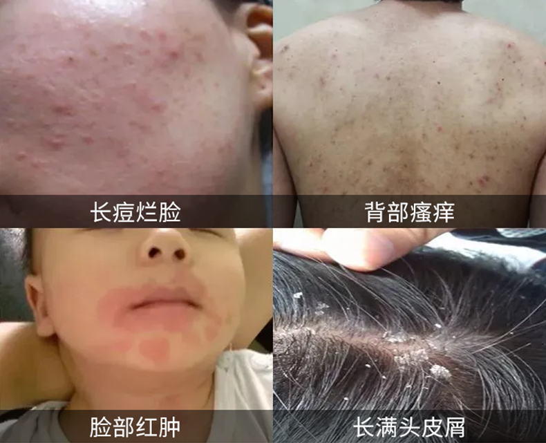 被子里的螨虫咬人吗_螨虫咬人后症状图片_怎么判断是螨虫咬的包