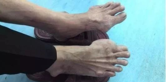 郭麒麟23岁就患痛风!痛风不再是中老年专属 郭麒麟23岁就患痛风!痛风不再是中老年专属