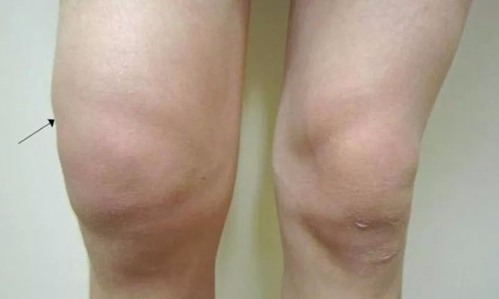 膝盖有积液?处理治疗一看就明白_医学界-助力医生临床决策和职业成长