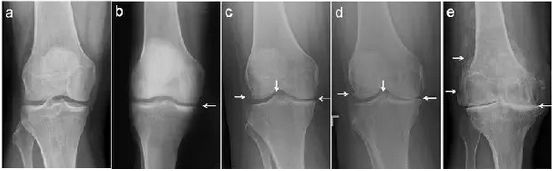 “滑膜炎”，“骨质增生”、“关节炎”如何区分？
