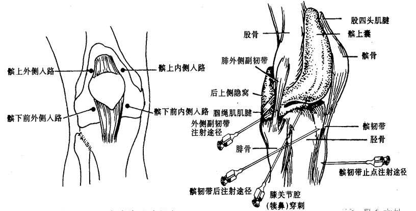 博鱼:
膝关节腔积液的原因及定位方法（一）——玻璃酸钠注射
