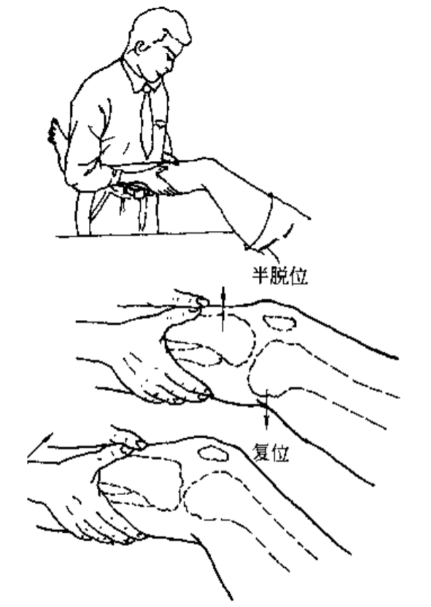 图21后交叉韧带断裂时,则相反的轴移试验阳性(reverse pivot shift