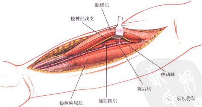 尺桡骨手术入路图片