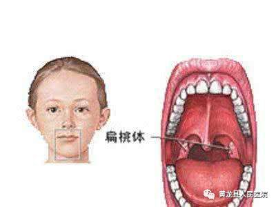 是位于口咽外侧壁腭咽弓和腭舌弓之间的三角形隐窝内的一个免疫器官