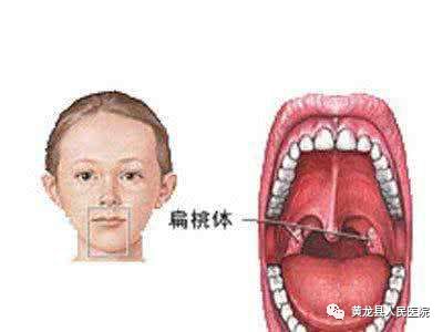 我們平時所說的扁桃體指的是顎扁桃體,是位於口咽外側壁顎咽弓和顎舌