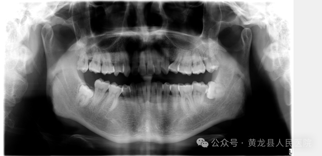 口腔ct怎么拍摄牙科CT拍片，让您手术安全有保障_https://www.jmylbn.com_新闻资讯_第4张