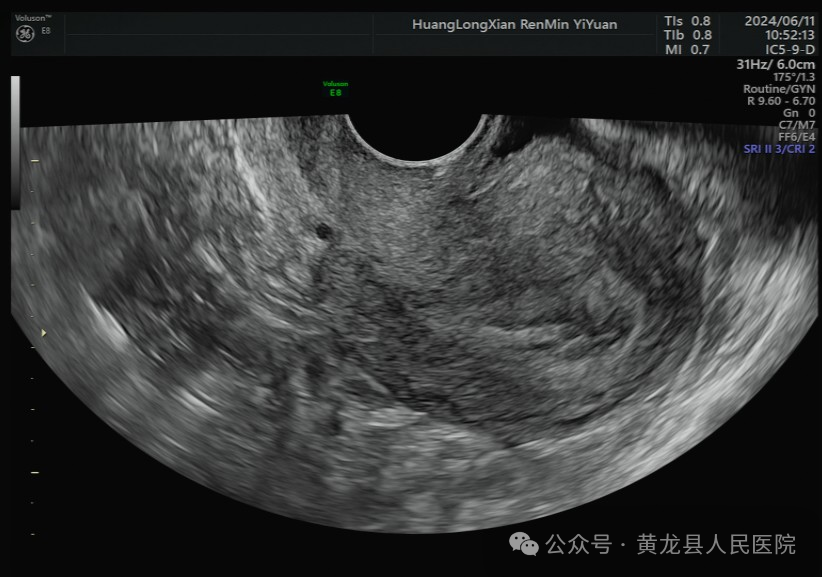 VOlusonE什么彩超机超声科GE Voluson E8四维彩超诊断仪，为女性健康护航！_https://www.jmylbn.com_新闻资讯_第3张