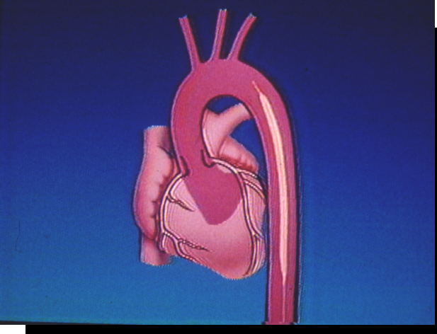 clearcuff加压袋为什么ICU知识小科普系列之IABP_https://www.jmylbn.com_新闻资讯_第8张