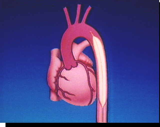 clearcuff加压袋为什么ICU知识小科普系列之IABP_https://www.jmylbn.com_新闻资讯_第7张