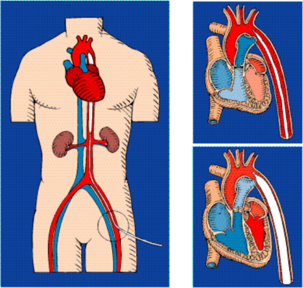 clearcuff加压袋为什么ICU知识小科普系列之IABP_https://www.jmylbn.com_新闻资讯_第6张