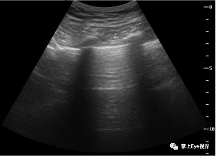 彩超伪像是什么超声基础 ｜ 超声伪像_https://www.jmylbn.com_新闻资讯_第2张