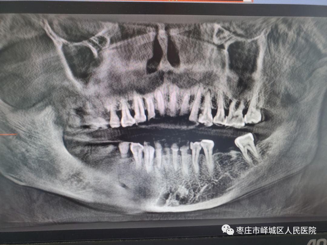 口腔ct怎么看您知道吗？口腔也可以做“CT”哦~_https://www.jmylbn.com_新闻资讯_第7张