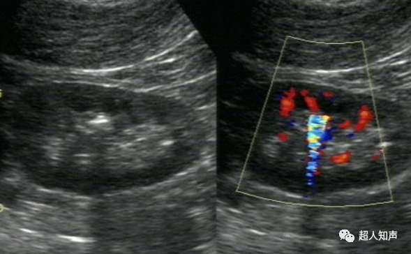 彩超伪像是什么超声伪像——多普勒超声伪像_https://www.jmylbn.com_新闻资讯_第1张