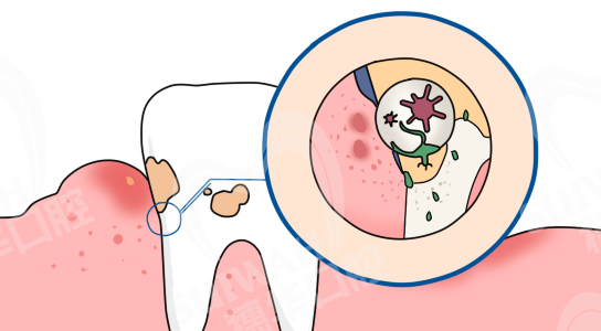2020-1-13头图-牙齿-
污垢.png