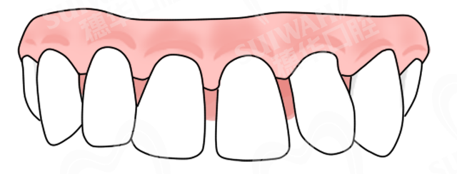 2019-12-5配图-
牙缝.png