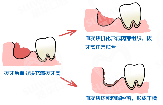 2020-1-5配图-
蛀牙.png